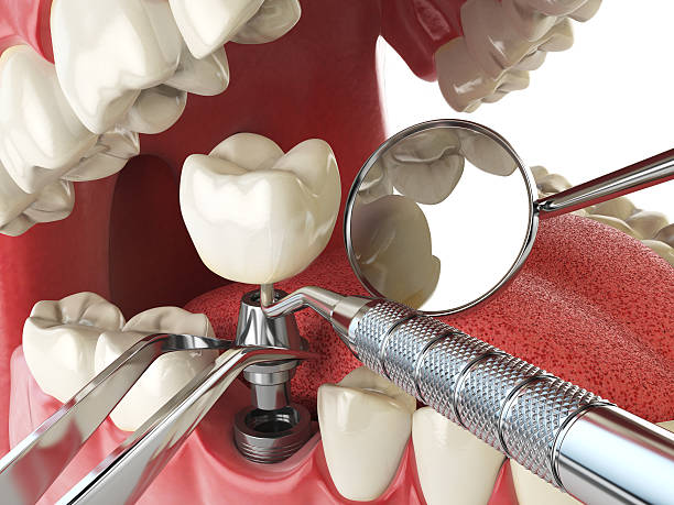 Best Emergency Dentist for Lost Fillings or Crowns in Rapids, NY